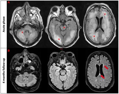 Investigating the association between neoplasms and MOG antibody-associated disease